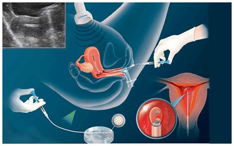 insemination Search